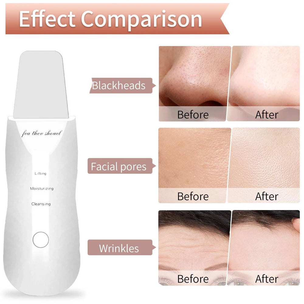 Ultrasonic Skin Scraper Peeling Blackhead Remover